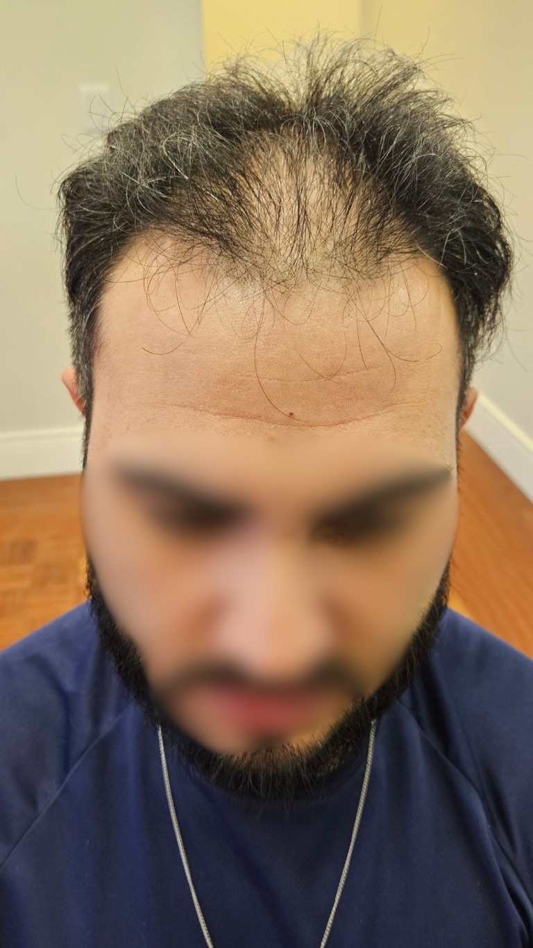 Paciente antes do transplante — caso 2